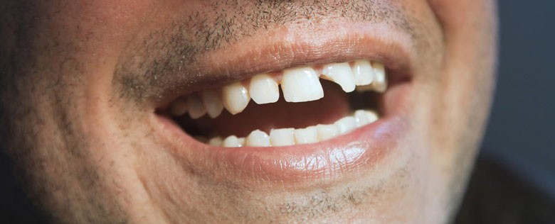 کامپوزیت دندان های جلو